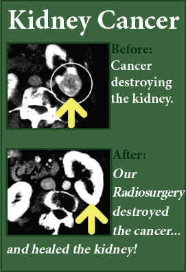 Kidney Cancer