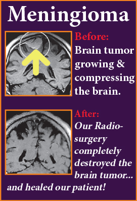 Brain Tumor