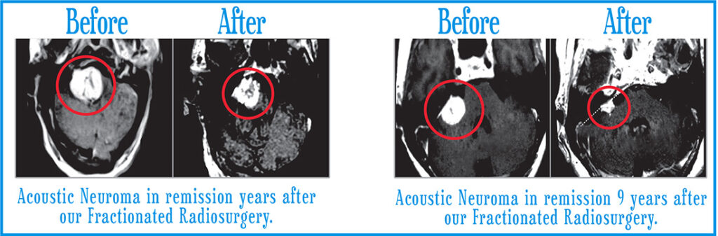 Acoustic Neuromas | Before and Afters