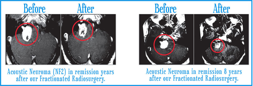 Acoustic Neuromas | Before and Afters