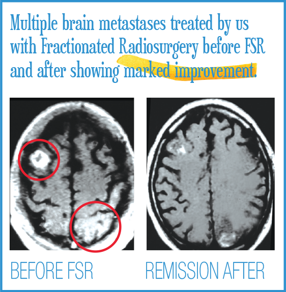 Brain Before and Afters