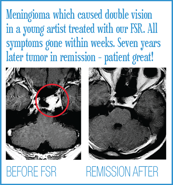 Brain Before and Afters