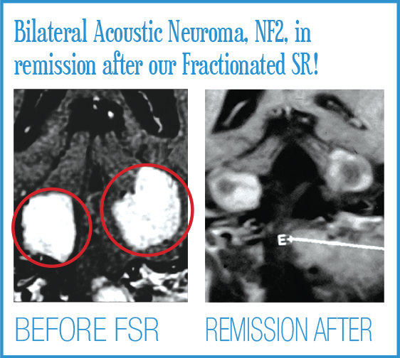 Brain Before and Afters