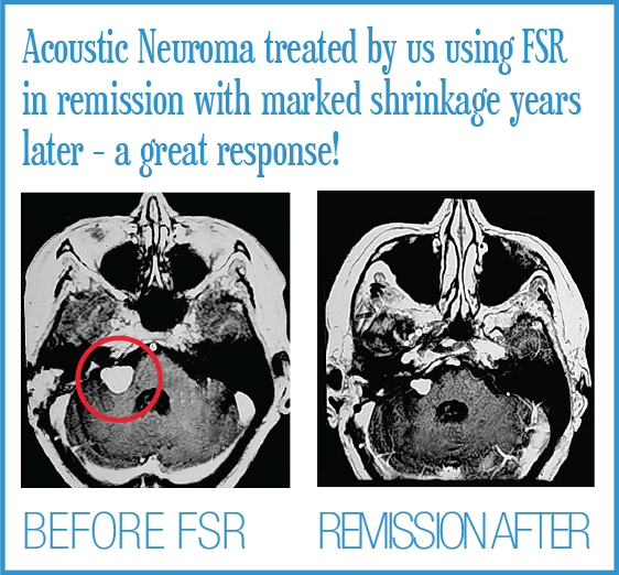 Brain Before and Afters