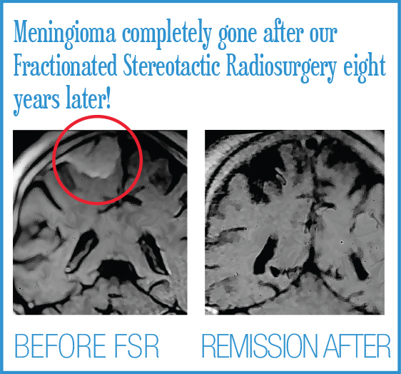 Brain Before and Afters