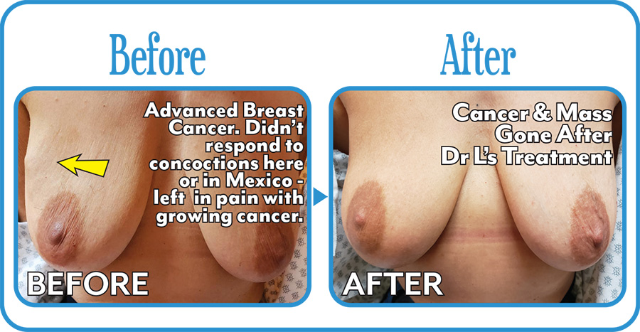 Breast Cancer Before & After