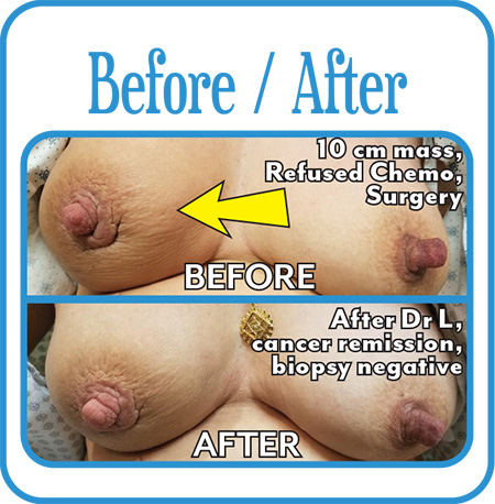 Breast Cancer Before & After