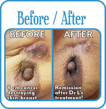 Breast Cancer Before & After