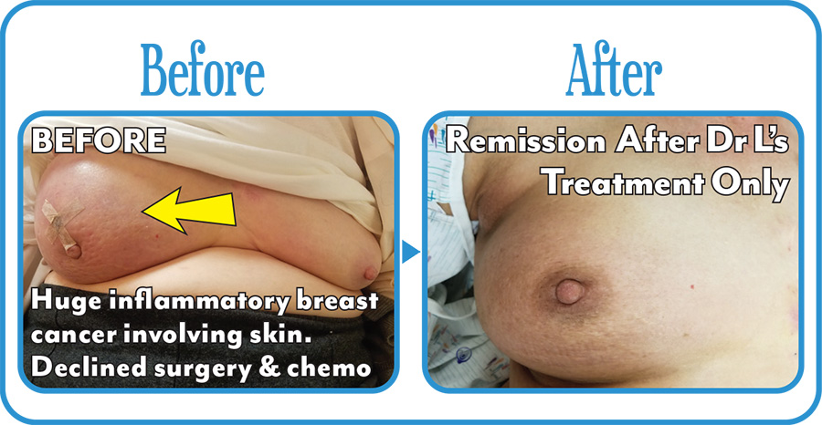 Breast Cancer Before & After