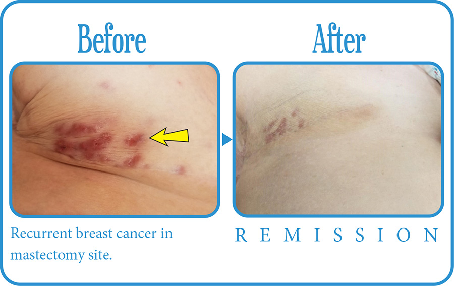 Breast Cancer Before After