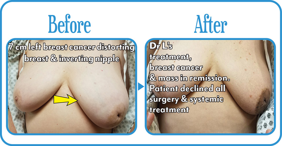 Breast Cancer Before & After