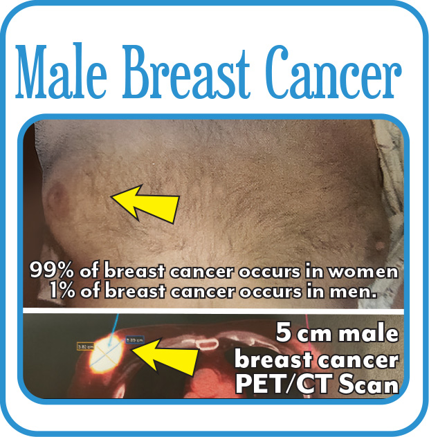 Male Breast Cancer