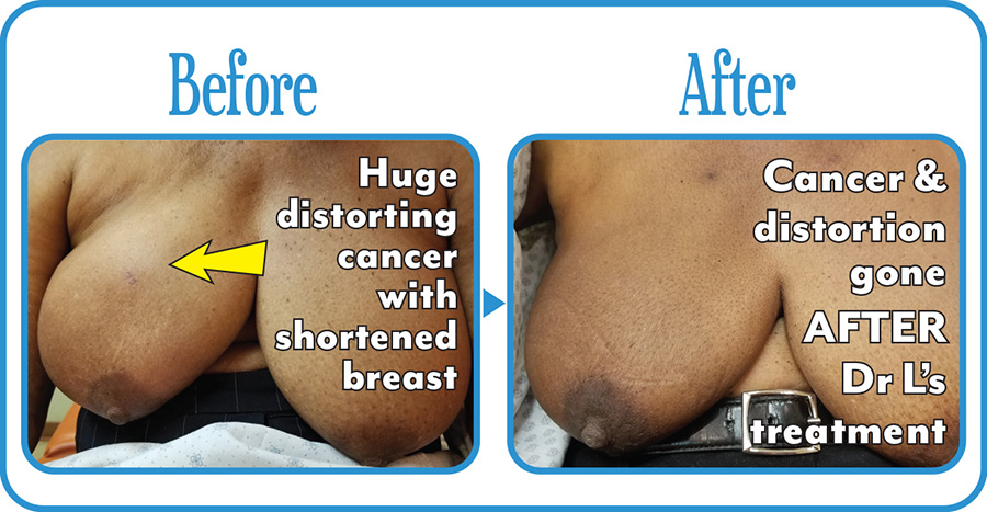 Breast Cancer Before & After