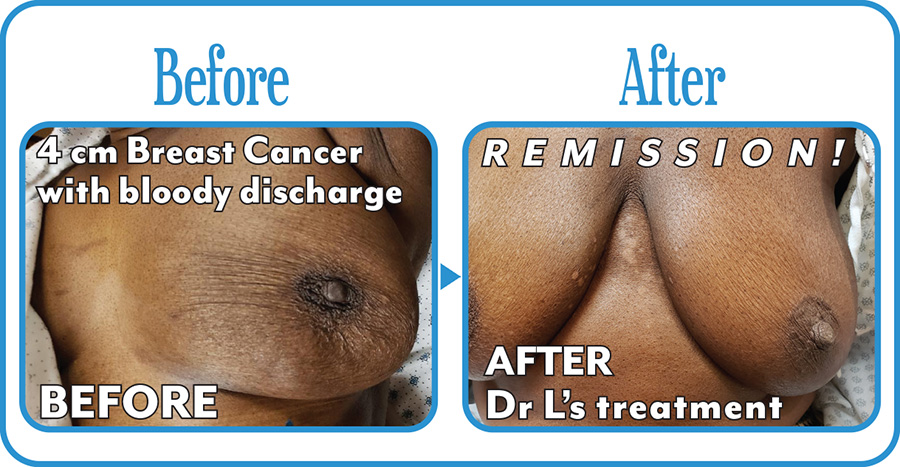 Breast Cancer Before & After