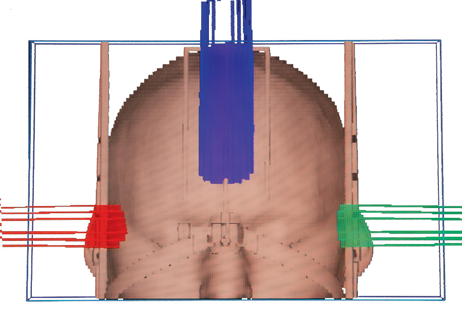 Man in Stereotactic Radiosurgery Frame