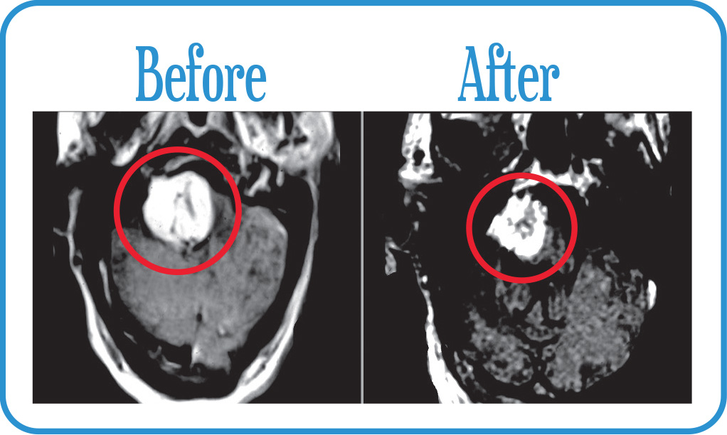 Acoustic Neuroma