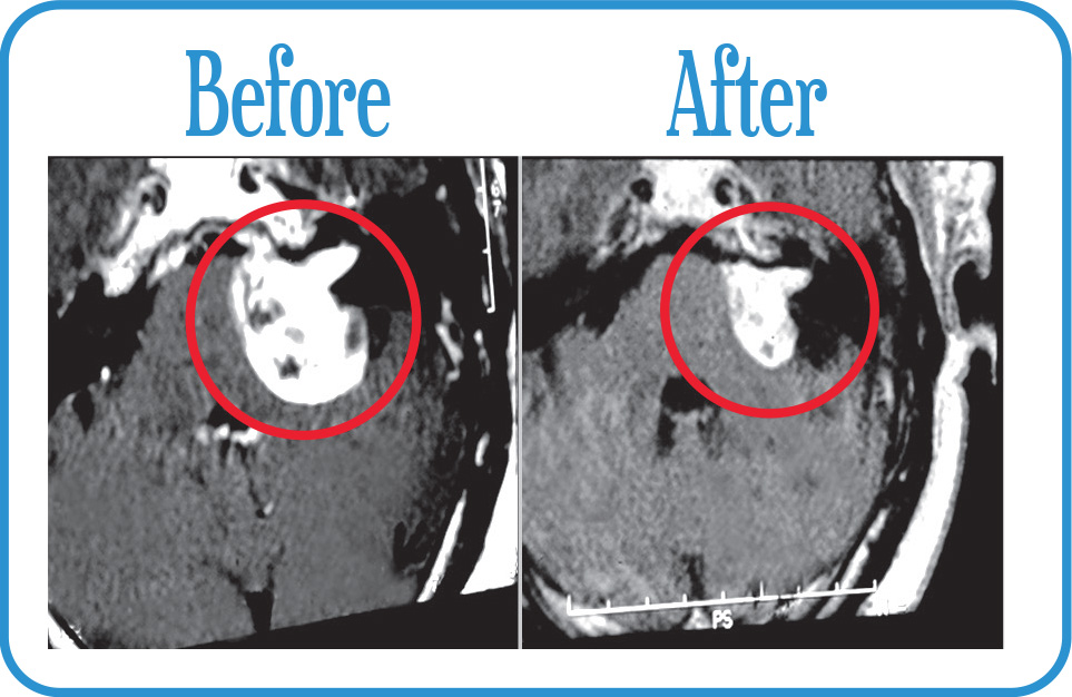 Acoustic Neuroma