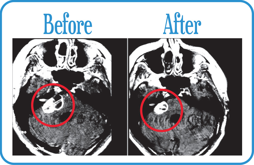 Acoustic Neuroma