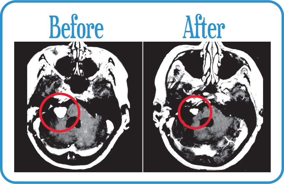 Acoustic Neuroma