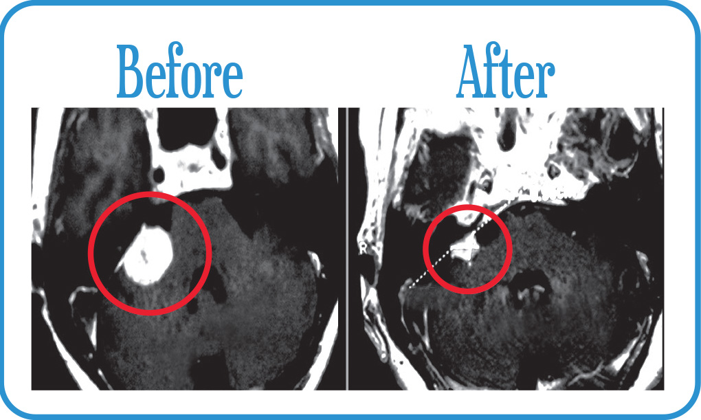 Acoustic Neuroma