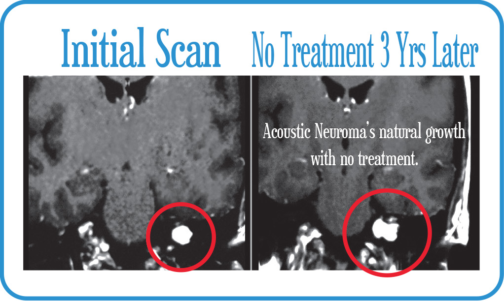 Acoustic Neuroma