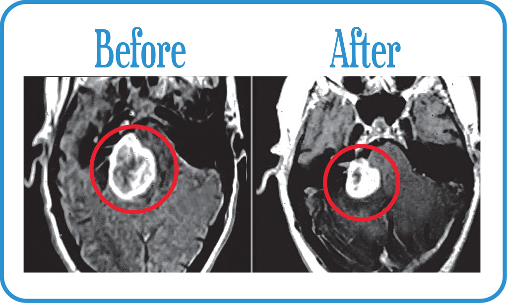 Acoustic Neuroma