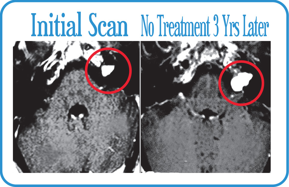 Acoustic Neuroma