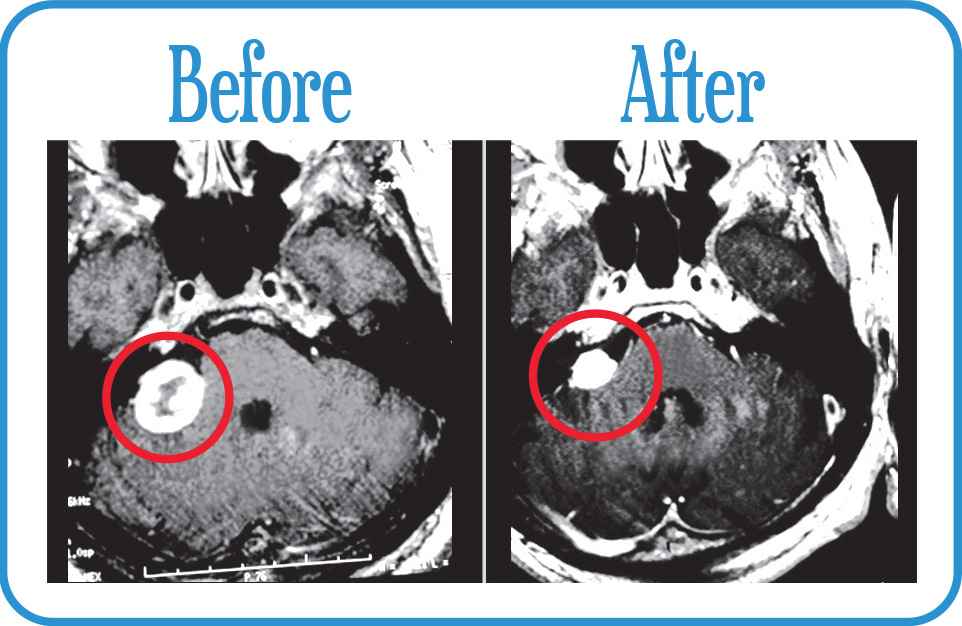 Acoustic Neuroma in remission 11 years.