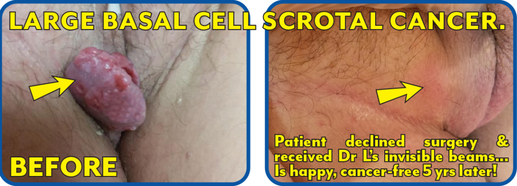 Basal Cell Scrotal Cancer