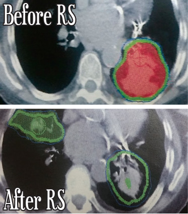 Bilateral Lung Cancer