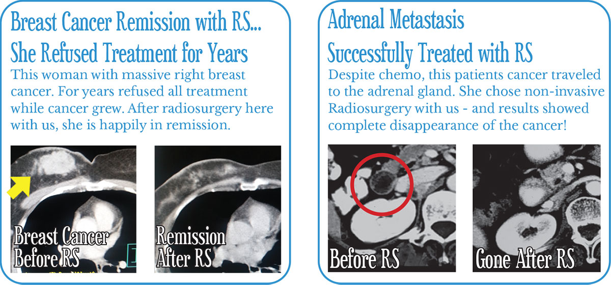 Breast cancer and Adrenal Mets