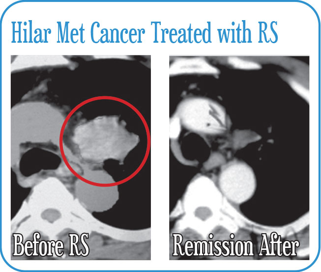 Hilar Met Cancer Treated with Radiosurgery