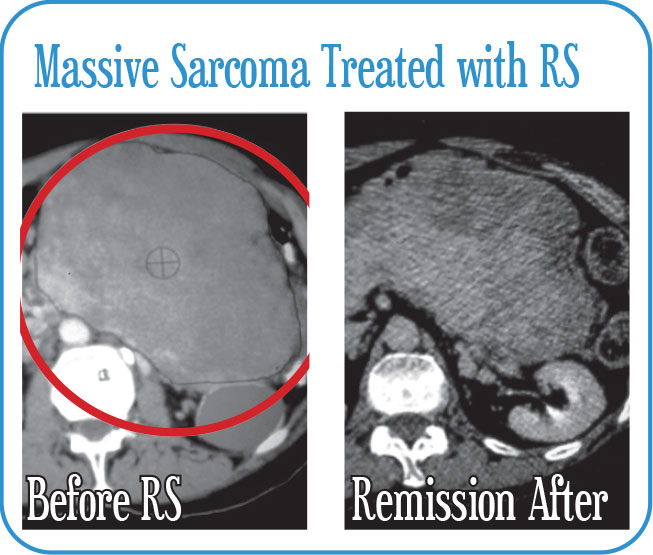 Massive Sarcoma Treated with Radiosurgery