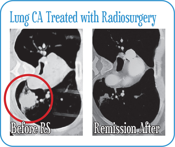 Lung Cancer Treated with Radiosurgery