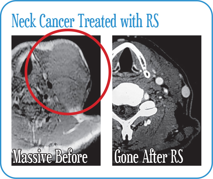 Neck Cancer Treated with Radiosurgery