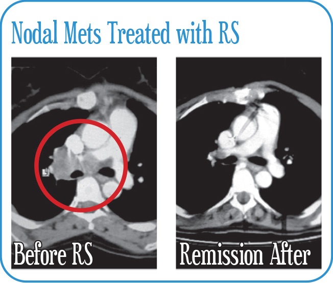 Nodal Mets Treated with RS