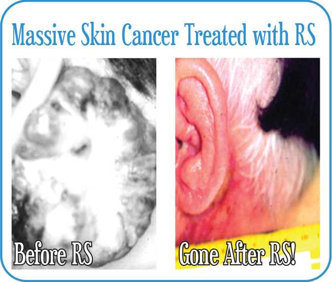 Massive Skin Cancer Treated with Radiosurgery