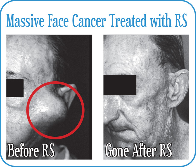 Massive Face Cancer Treated with Radiosurgery