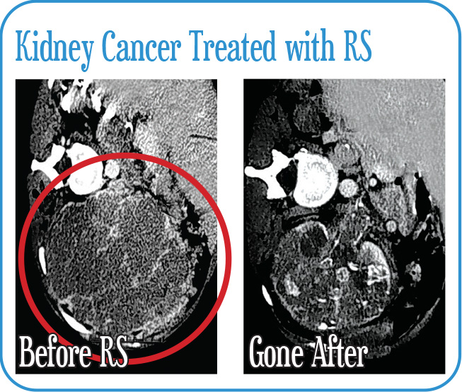 Kidney Cancer Treated with Radiosurgery