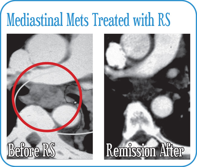 Mediastinal Mets Treated with Radiosurgery