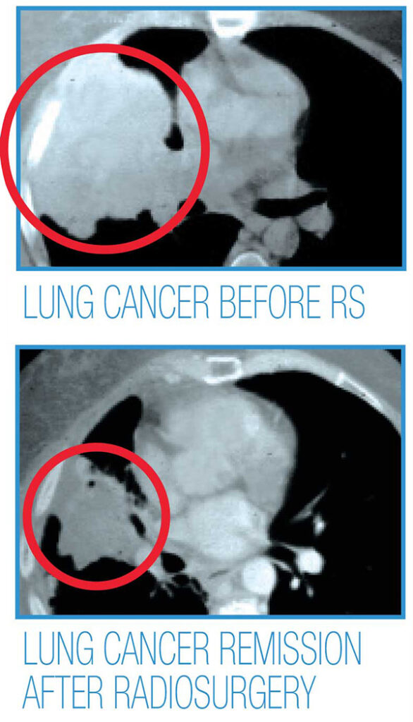 Lung Cancer Before and After Radiosurgery