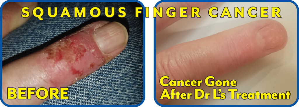 Finger Cancer