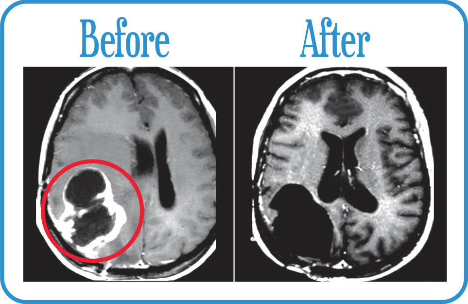 Glioblastoma