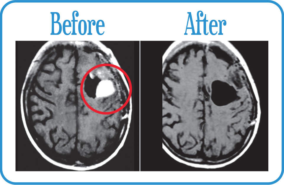 Glioblastoma