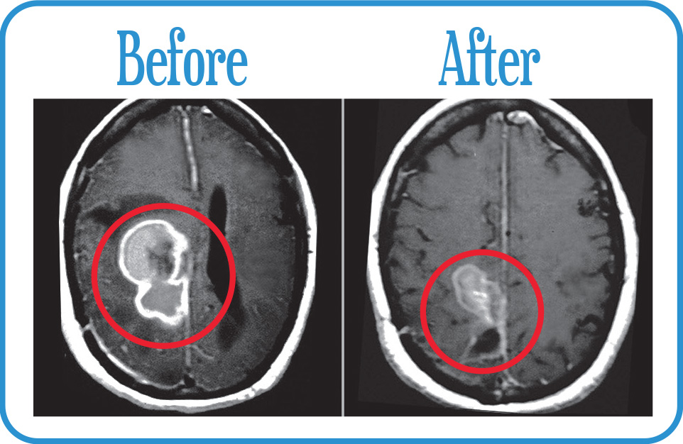 Glioblastoma