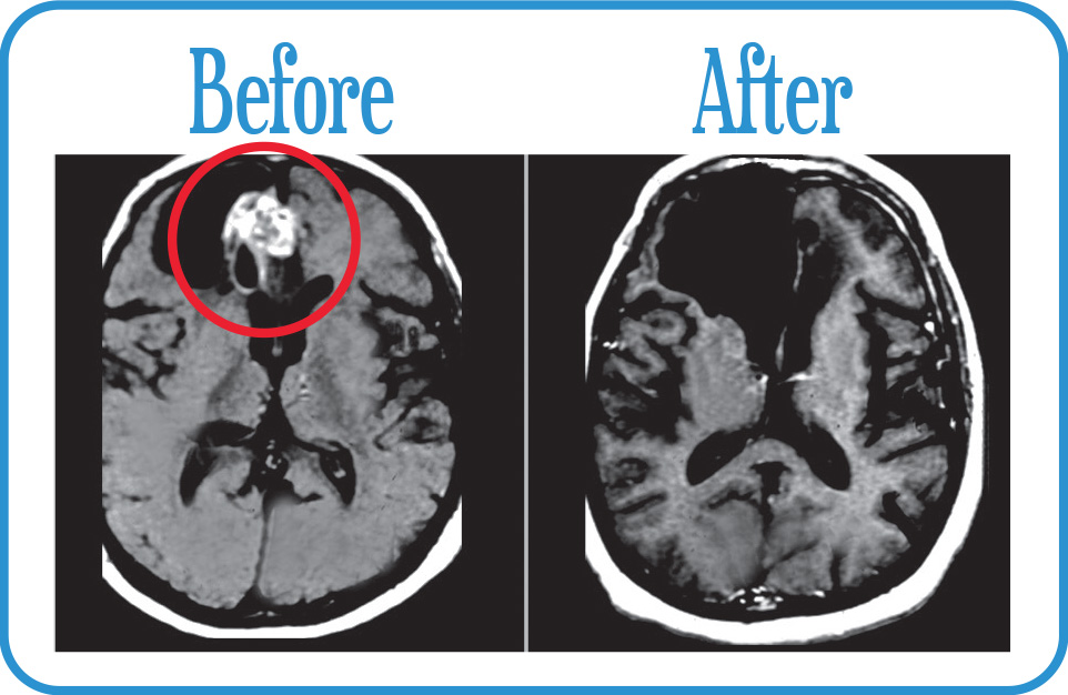 Glioblastoma