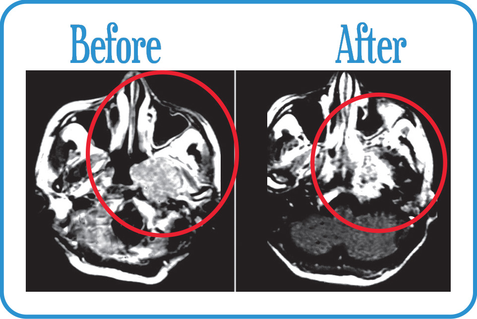 Head and Neck Cancers