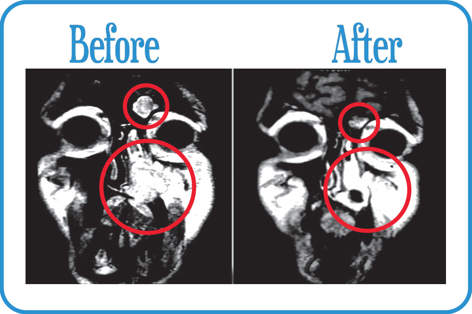 Head and Neck Cancers