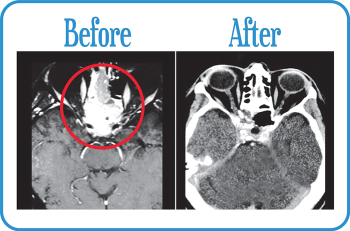 Head and Neck Cancers