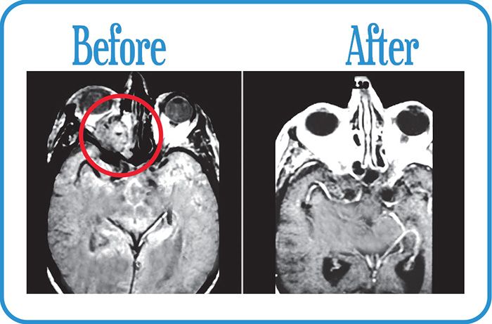 Head and Neck Cancers